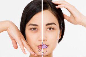 لیفت شقیقه - همه چیز درباره لیفت صورت و ابرو